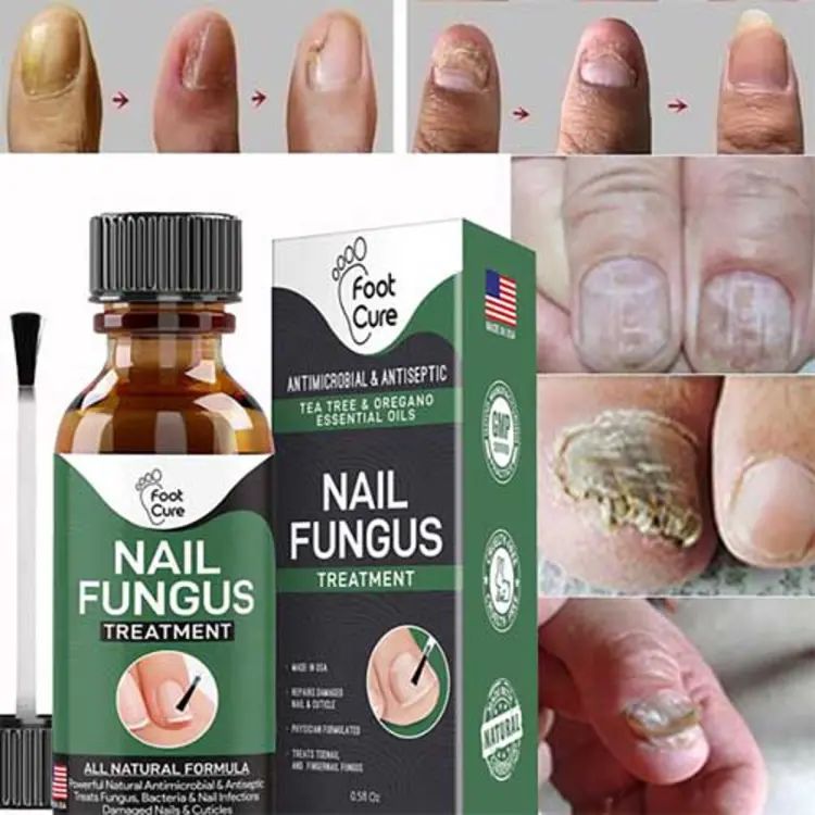 Nail Fungus Treatment Stop Fungal Growth